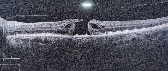 buraco macular