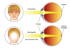 buraco macular